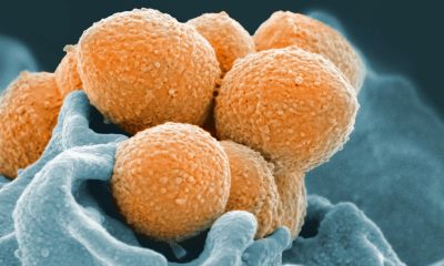 An electron microscope image shows Group A Streptococcus in orange