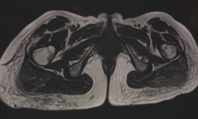 X-rays show the foreign substances still in Brittany Rowe's body after an illegal cosmetic procedure at an underground clinic in Vaughan.