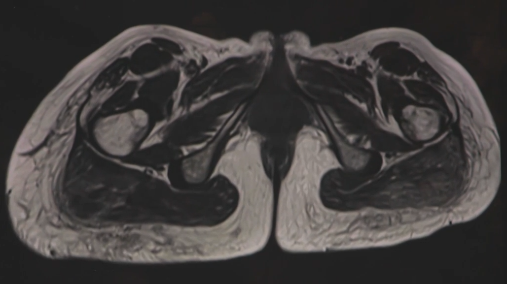 X-rays show the foreign substances still in Brittany Rowe's body after an illegal cosmetic procedure at an underground clinic in Vaughan.