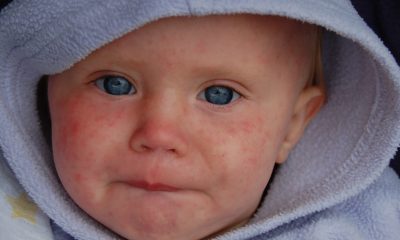 A child with a measles infection