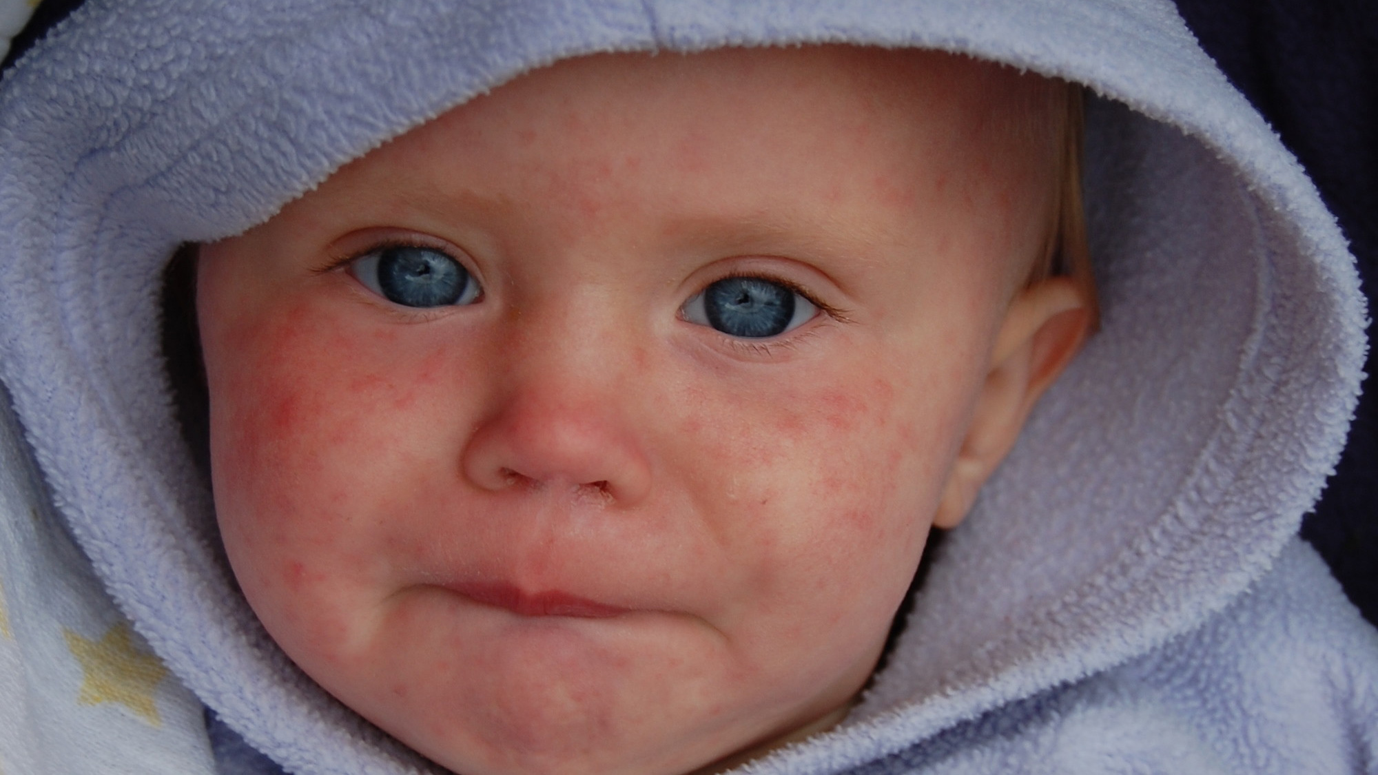 A child with a measles infection