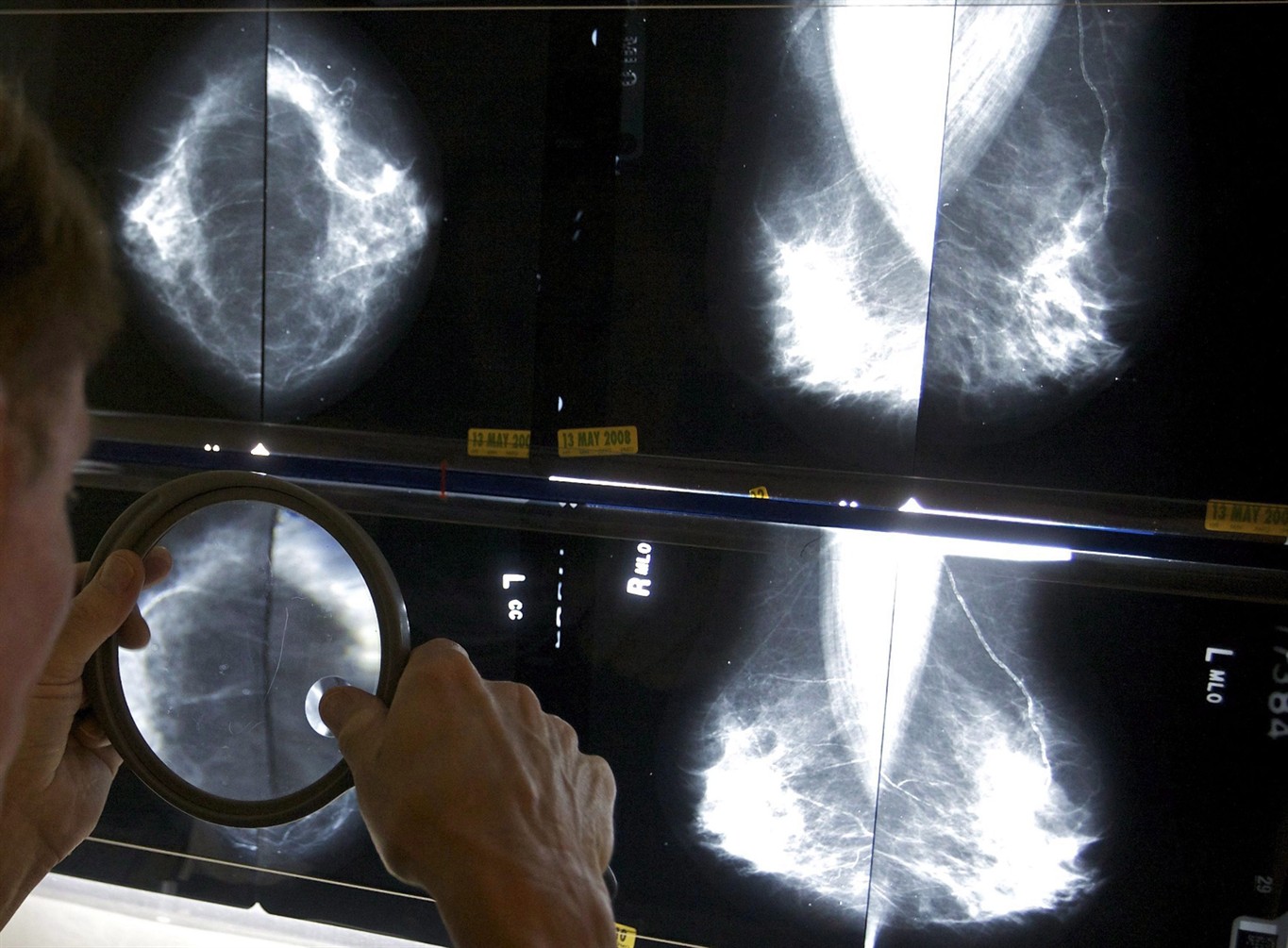 A radiologist checks mammograms for breast cancer